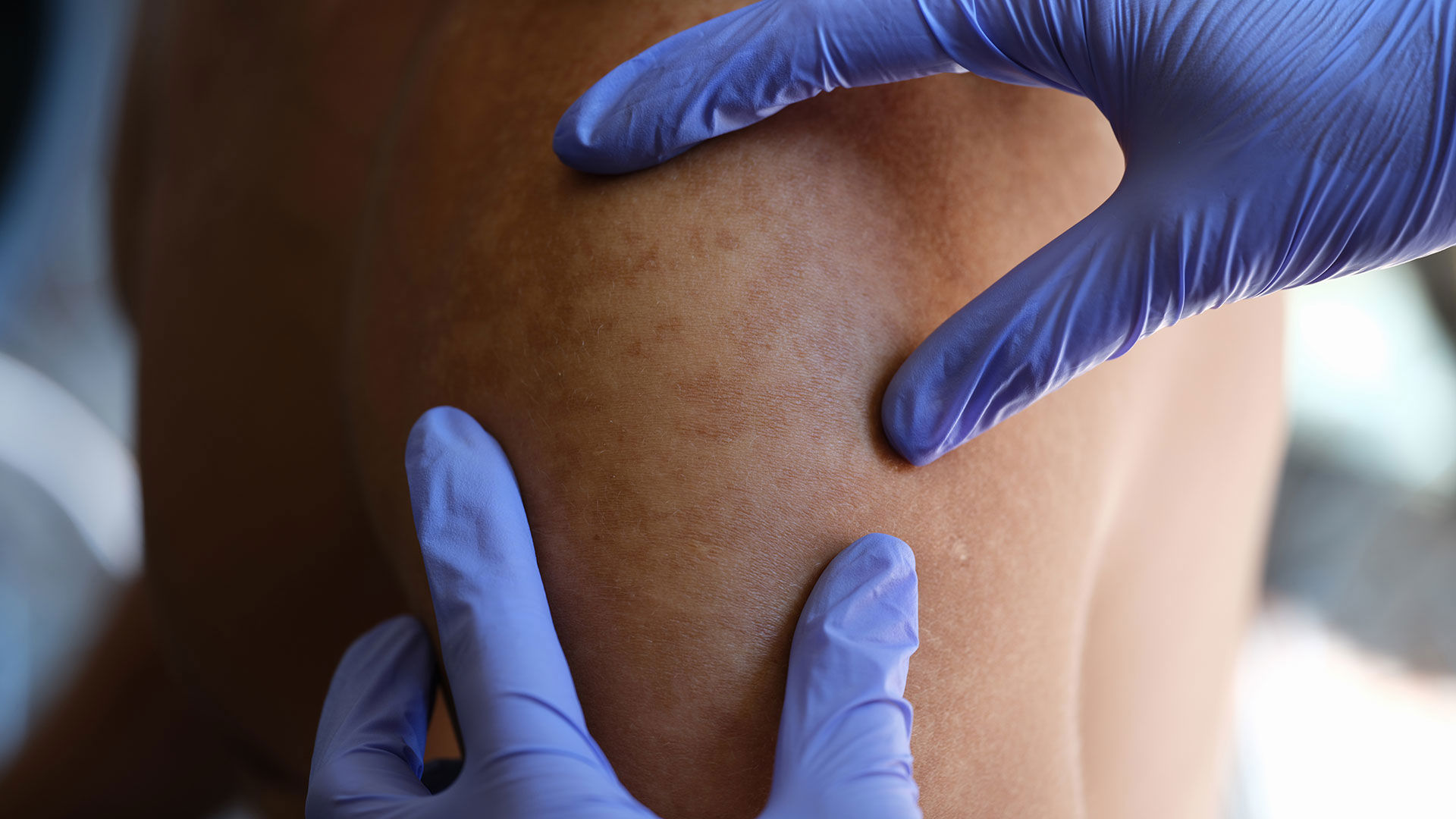 En læge der kigger på huden på en skulder