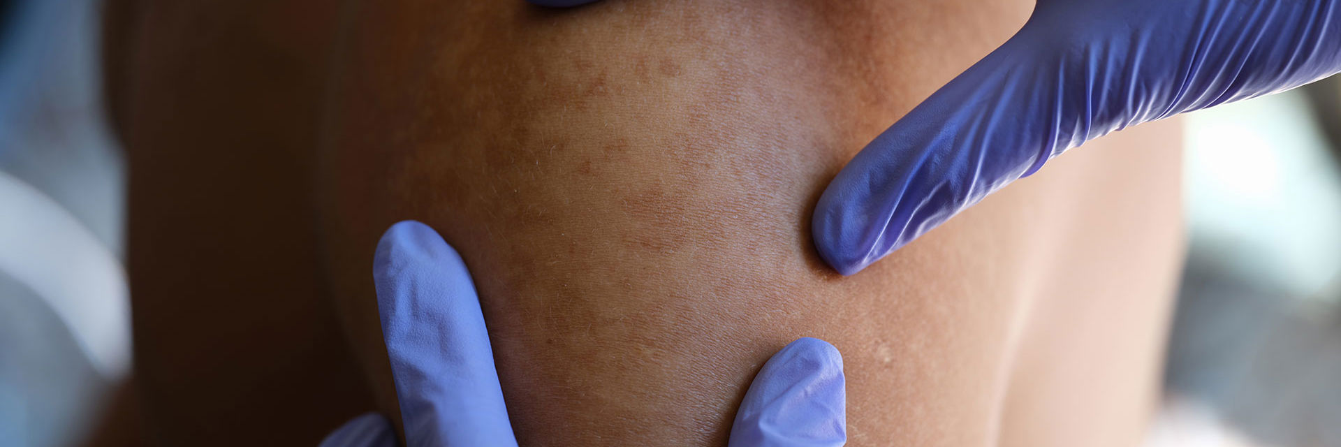 En læge der kigger på huden på en skulder